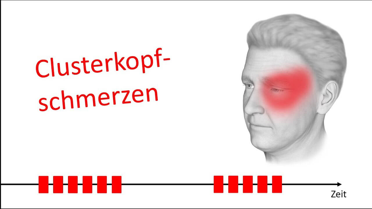 Clusterkopfschmerzen: starker, einseitiger Schmerz um das Auge, zeitlich gehäuft.