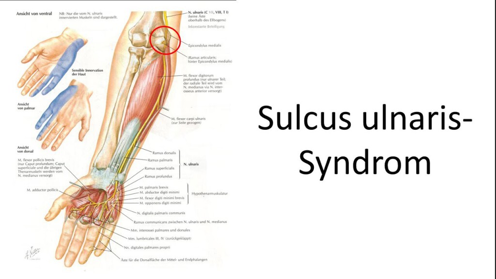 Sulcus-ulnaris-Syndrom