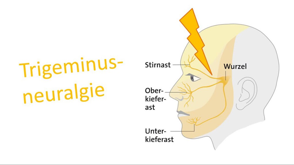 Trigeminusneuralgie